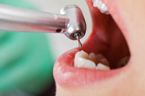 Best Emergency Dental Extractions in Lamar, MO